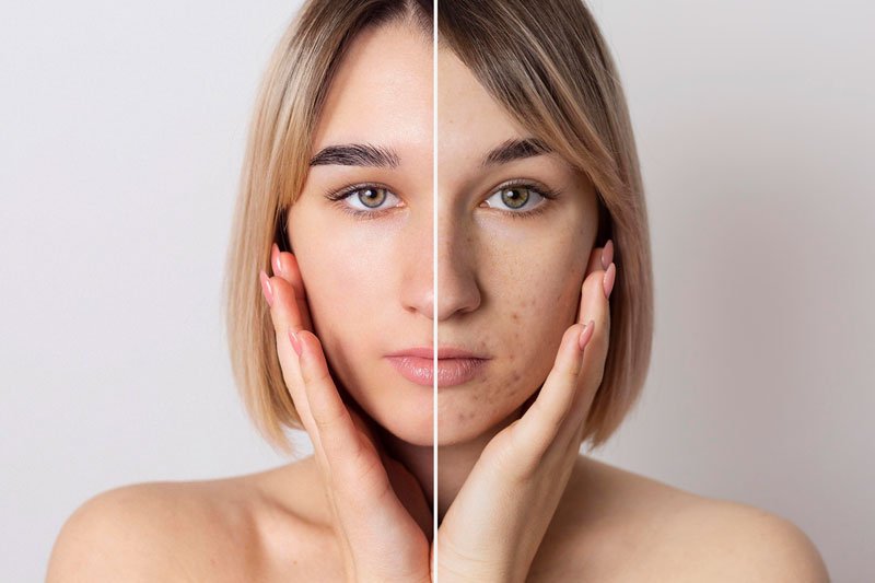 Pele e marcas de acne — imagem demonstrativa